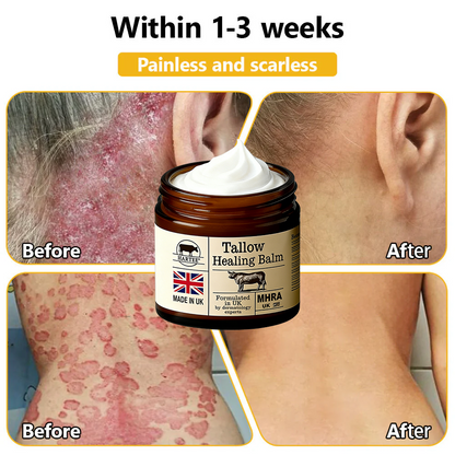 HARTEE® Tallow Healing Balm🐄（GMP Facility • FDA-Registered • Dermatologist Tested👨‍⚕️）Soothe eczema, psoriasis & rosacea—without steroids.🐄