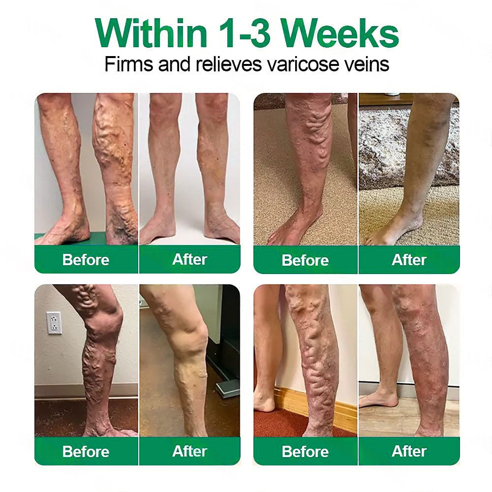 🇬🇧👨‍⚕️✅Pureluxo® VenoEase Soluble Microneedle Patch⚡Instant Relief, Long-Term Results 🔥