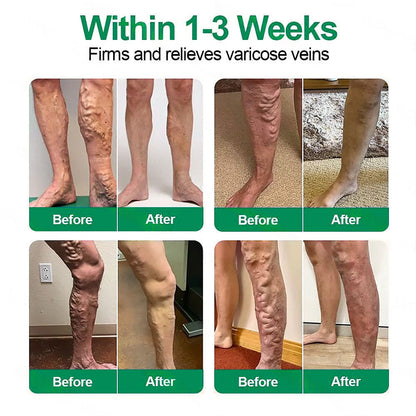 🇬🇧👨‍⚕️✅Pureluxo® VenoEase Soluble Microneedle Patch⚡Instant Relief, Long-Term Results 🔥